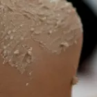 ニキビ